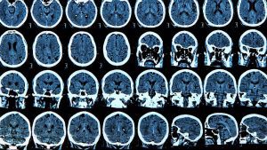 COVID può causare anomalie cerebrali "significative" fino a sei mesi, affermano i ricercatori
