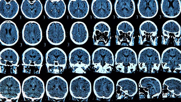 COVID può causare anomalie cerebrali "significative" fino a sei mesi, affermano i ricercatori