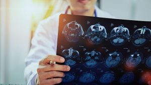 La tecnologia AI ha contribuito a triplicare il recupero dei pazienti da ictus in Inghilterra