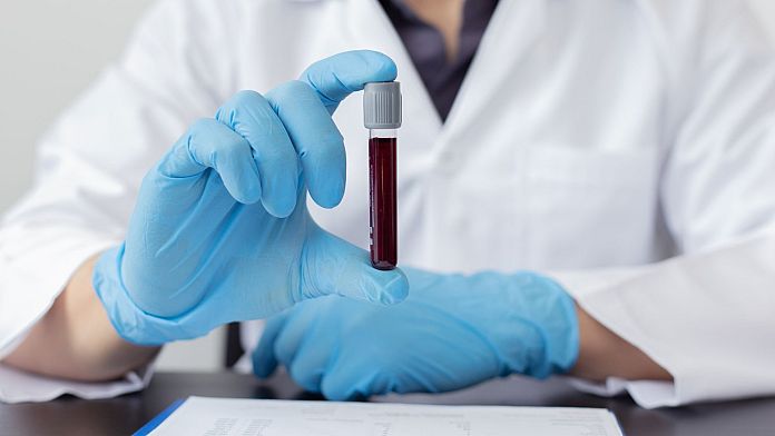 L'esame del sangue potrebbe rilevare la malattia di Alzheimer anni prima che i sintomi emergano
