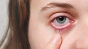 Miti sulla cataratta pediatrica