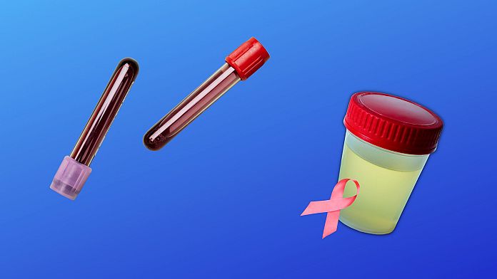 Un nuovo esame del sangue economico può rilevare 14 tipi di cancro prima che si diffondano