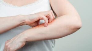 stress dovuto alla psoriasi