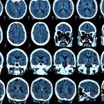 COVID può causare anomalie cerebrali "significative" fino a sei mesi, affermano i ricercatori