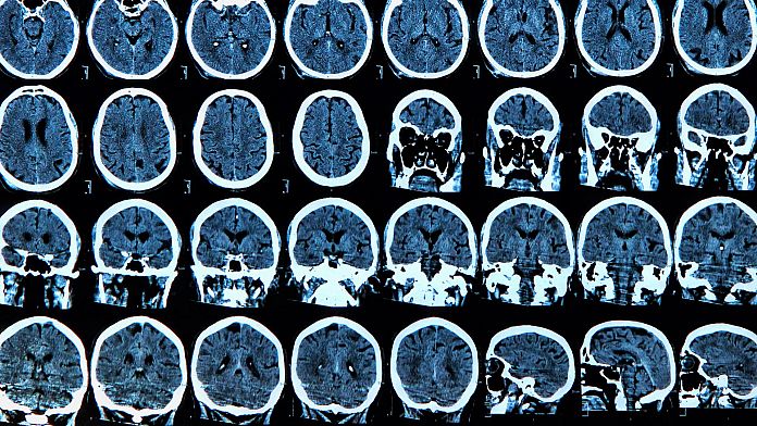 COVID può causare anomalie cerebrali “significative” fino a sei mesi, affermano i ricercatori
