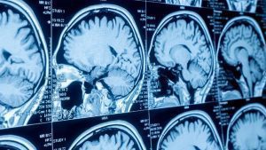 Gli esperti salutano il primo farmaco per rallentare l'insorgenza della malattia di Alzheimer