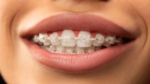 come raddrizzare i denti