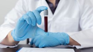 L'esame del sangue potrebbe rilevare la malattia di Alzheimer anni prima che i sintomi emergano