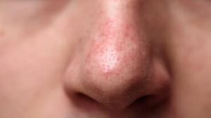 Come trattare i pori ostruiti