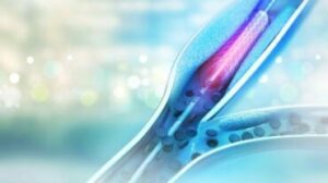 Trattamento di angioplastica per pazienti cardiopatici