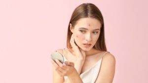 maschera per il viso per l'acne