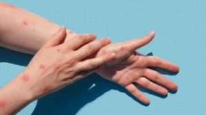 sintomi della varicella