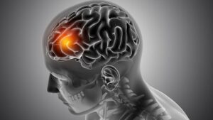 Gli scienziati hanno trovato un modo per far morire di stress le cellule del cancro al cervello