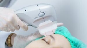 Trattamento viso HIFU