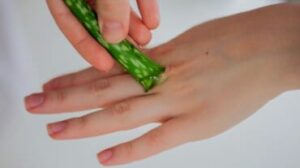 Rimedi per le ustioni