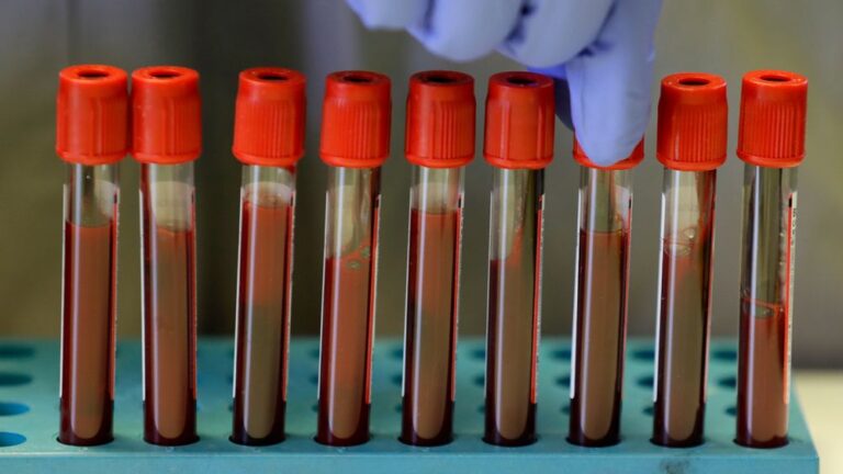 Un nuovo esame del sangue per il Parkinson potrebbe aiutare i medici a rilevarlo prima