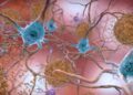 This illustration depicts cells in an Alzheimer’s affected brain, with abnormal levels of the beta-amyloid protein forming plaques, brown, that collect between neurons.