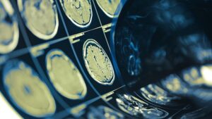 Un chip cerebrale può leggere le menti delle persone con una precisione fino al 74%