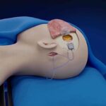 Tecnologia Cerebrale: Uomo Paralizzato Controlla Dispositivi in 5 Giorni