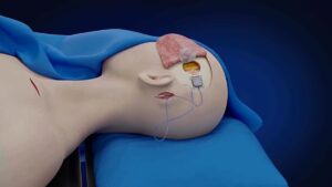 Tecnologia Cerebrale: Uomo Paralizzato Controlla Dispositivi in 5 Giorni